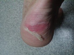 Blisters!