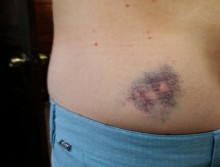 My bruised butt